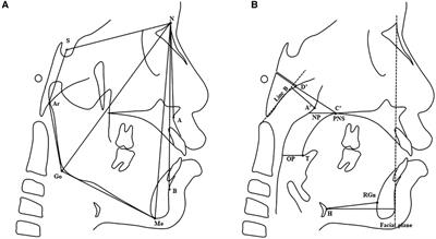 Craniofacial and upper airway morphological characteristics associated with the presence and severity of obstructive sleep apnea in Chinese children
